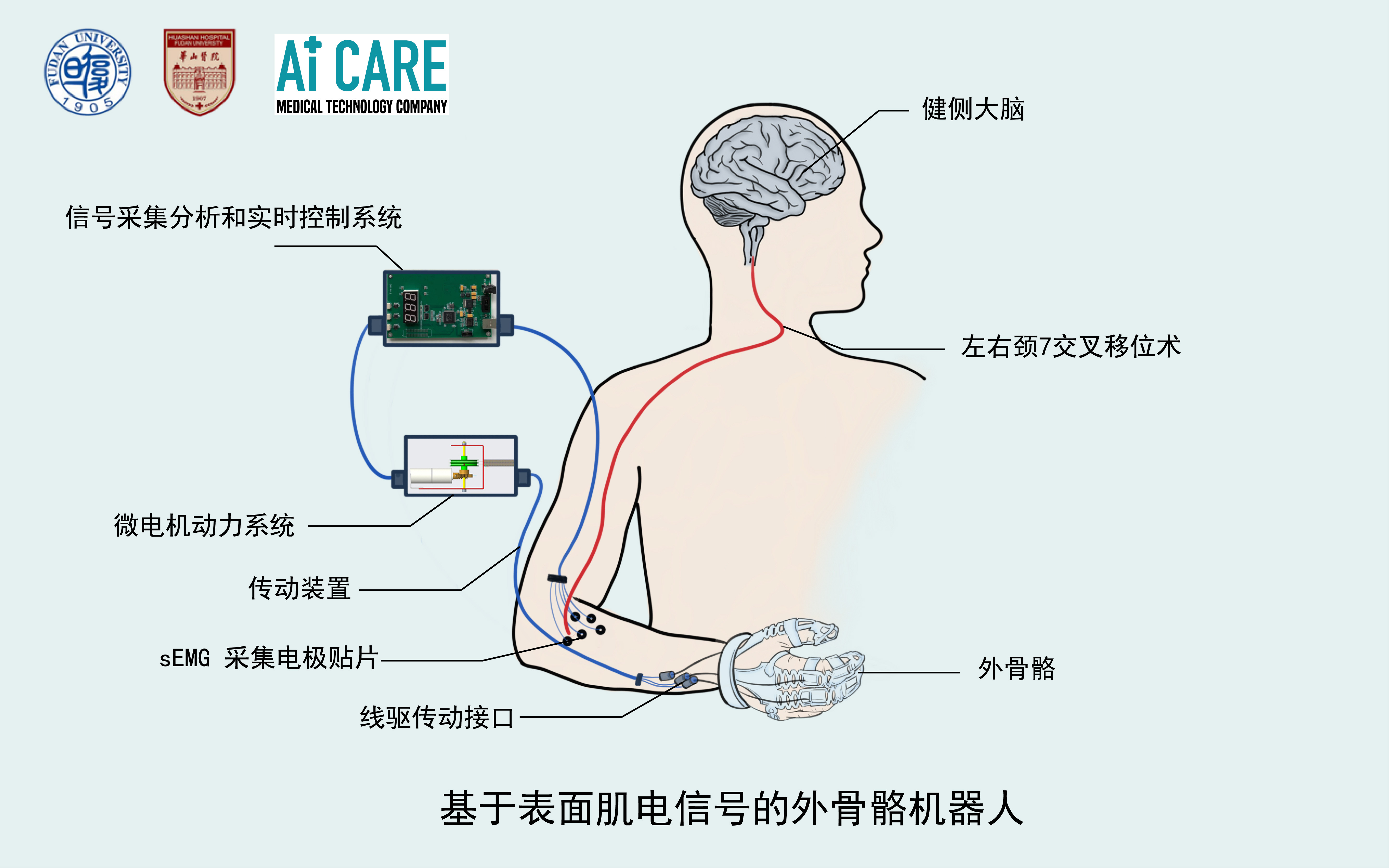 可穿戴智能手套_健身手套 推荐_瘫痪手康复辅助