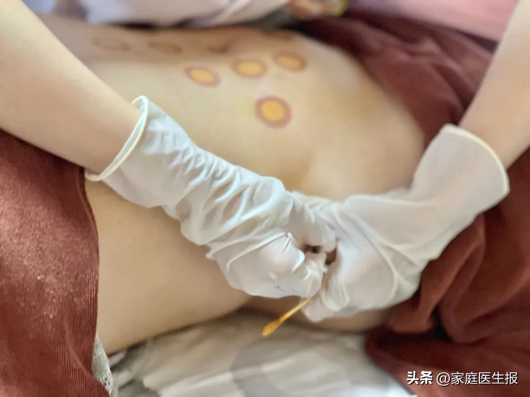 腹部埋线减肥优势_痰湿型肥胖埋线减肥_局部减肥有用吗