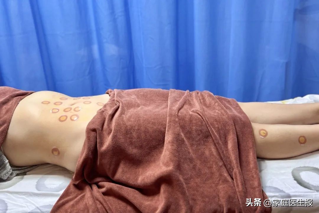 痰湿型肥胖埋线减肥_腹部埋线减肥优势_局部减肥有用吗