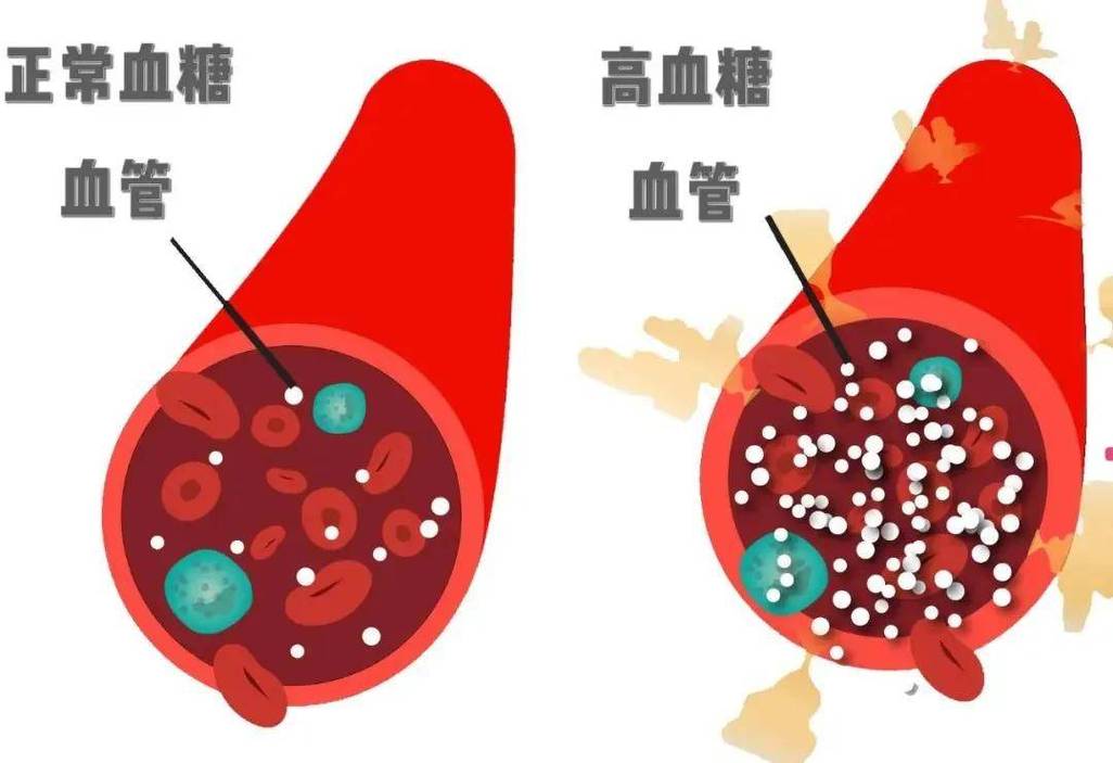 孕妇血糖高可以吃什么_绿豆秋葵洋姜黑木耳葛根粉控血糖食物低升糖指数糖尿病饮食管理