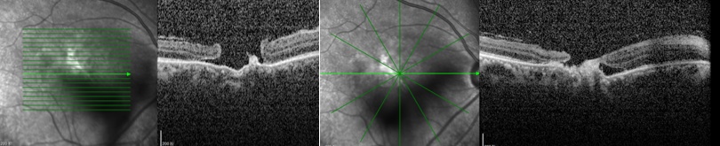 医美激光眼睛损伤_黄斑裂孔激光治疗_孕妇可以用美容仪吗