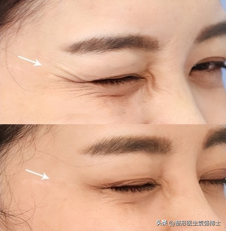 电波拉皮除皱做几次能除皱_改善抬头纹_改善鱼尾纹