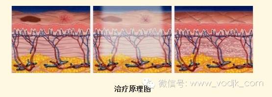 光子嫩肤适合人群_光子嫩肤风险及注意事项_电波拉皮除皱做几次能除皱