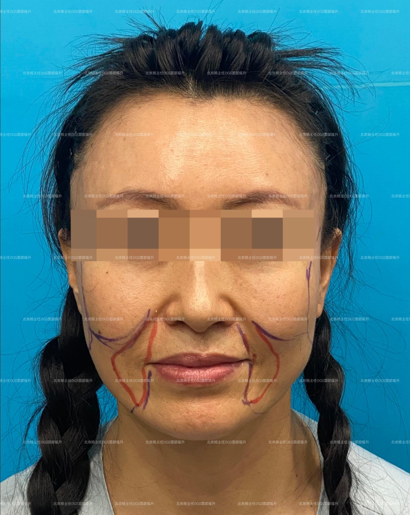 电波拉皮除皱做几次能除皱_面部提升手术_北京面部提升医院