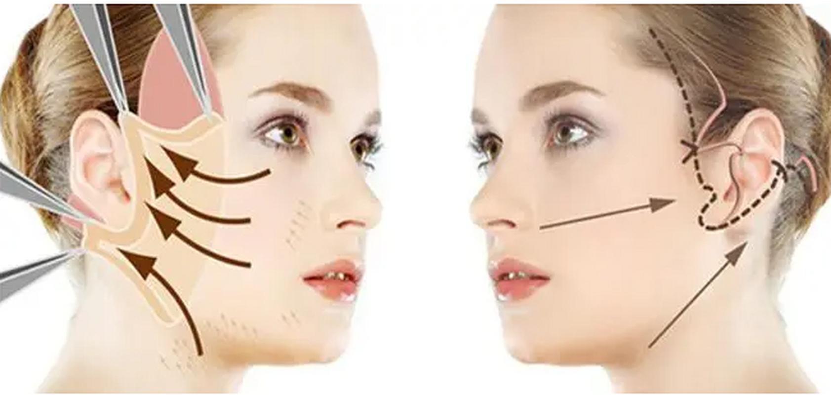 小拉皮手术是什么_小拉皮术适合多大年龄_电波拉皮除皱做几次能除皱