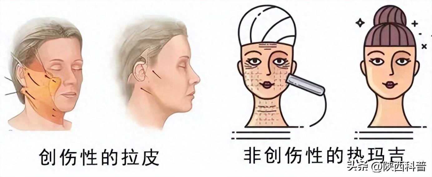 如何去除法令纹_电波拉皮除皱做几次能除皱_法令纹形成原因