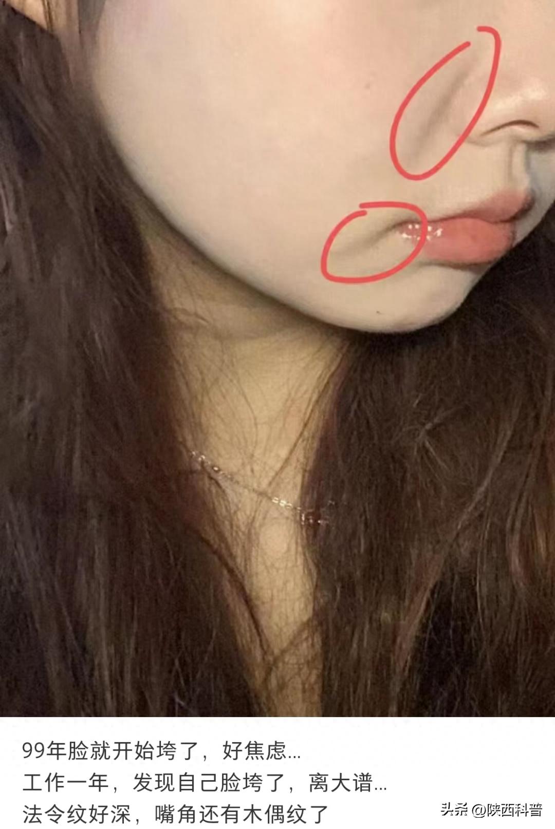 如何去除法令纹_电波拉皮除皱做几次能除皱_法令纹形成原因