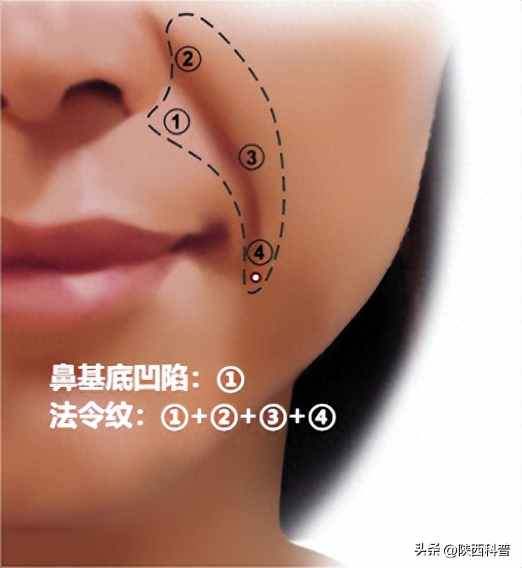 电波拉皮除皱做几次能除皱_法令纹形成原因_如何去除法令纹