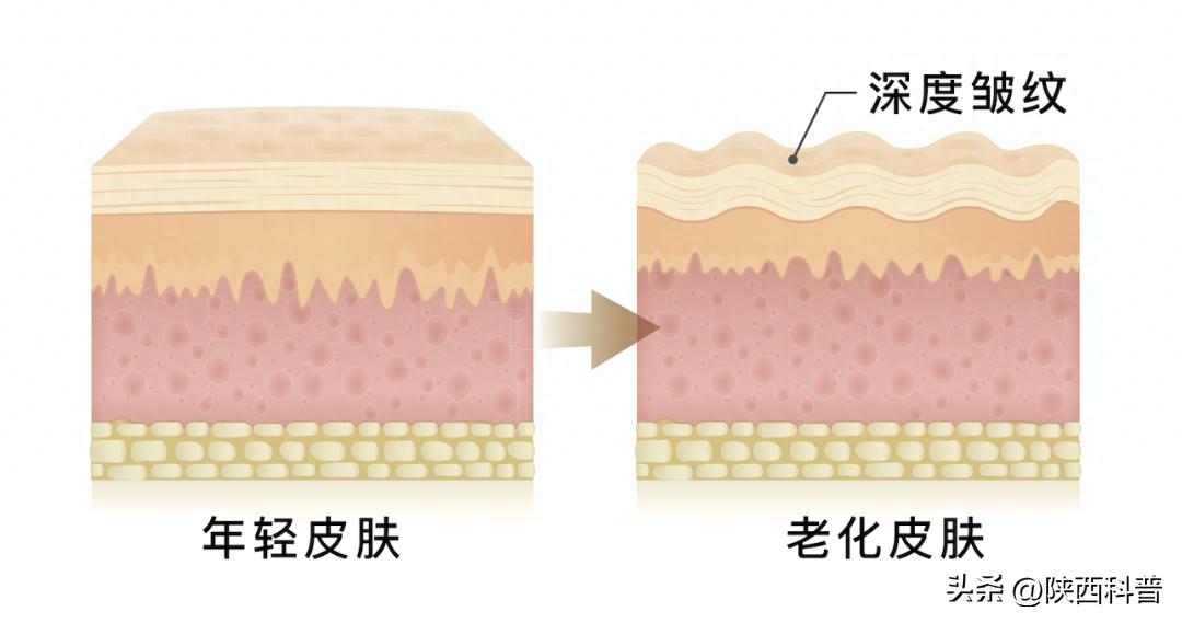 如何去除法令纹_法令纹形成原因_电波拉皮除皱做几次能除皱
