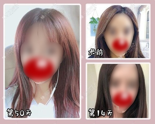 大眼综合效果案例图