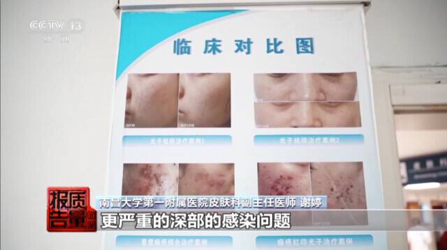 针清祛痘危害_美容院祛痘_美容院做脸部护理好吗