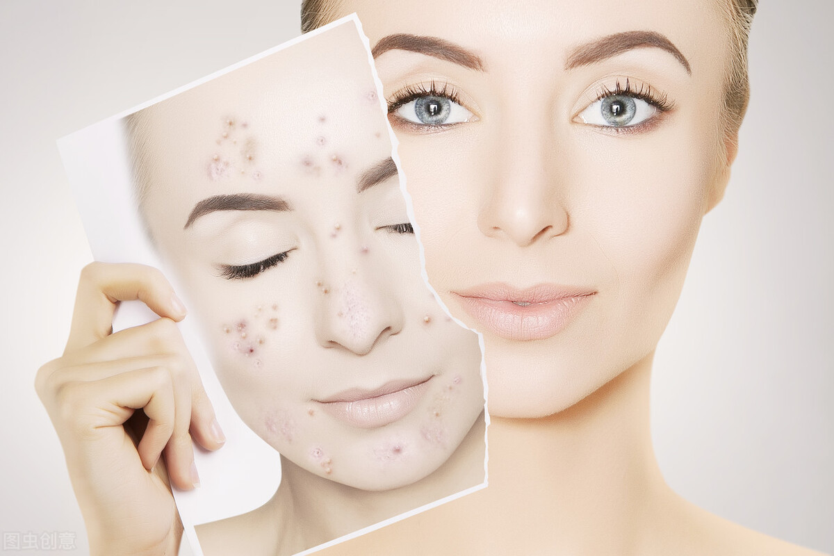 能挤的痘痘_痘痘里的血要挤干净吗_痘痘怎么挤不留印