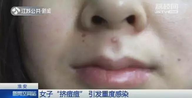 痘痘里的血要挤干净吗_脸上痘痘感染_危险三角区挤痘后果