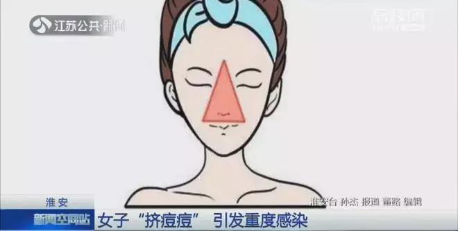 痘痘里的血要挤干净吗_危险三角区挤痘后果_脸上痘痘感染