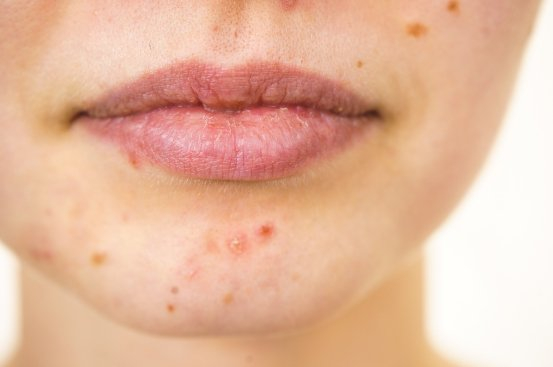 痤疮反复发作原因_脸上长痘痘要吃什么_如何减少痘痘复发