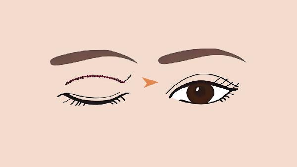 双眼皮贴使用危害_使用双眼皮纤维的坏处_眼皮松弛过敏反应